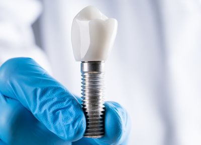 Wie lange braucht die Prothese nach der Implantation?