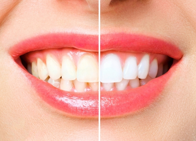 Is teeth whitening safe?